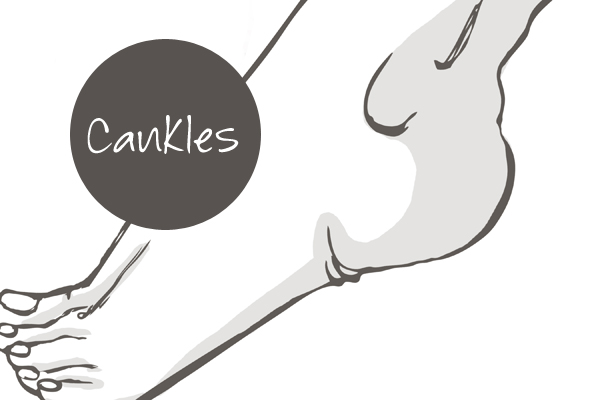 Cankles